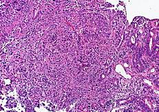 胃の腺癌細胞